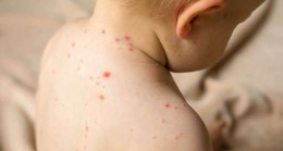 İnegöl’de kızamık vakalarında artış